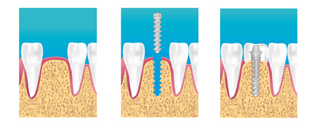 Les phases de la pose d'un Implant dentaire à Paris 16 eme