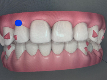 Invisalign Paris 16