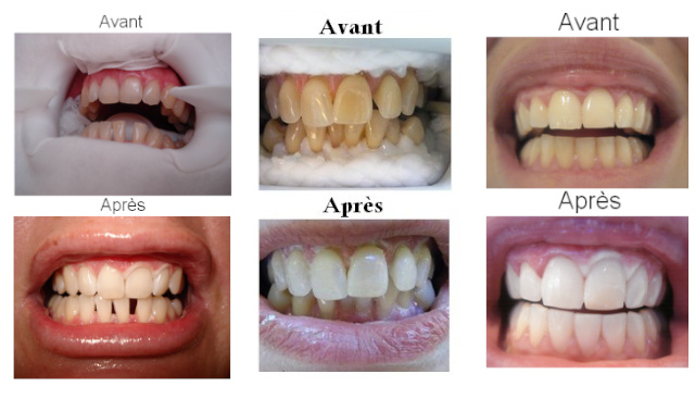 Gouttière dentaire Tunisie : technique blanchiment dentaire